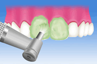 歯面のクリーニング